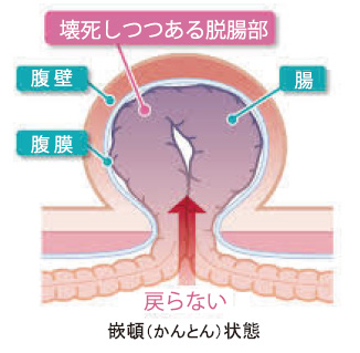 病気のはなし そけいヘルニア 脱腸 について 公立学校共済組合 関東中央病院