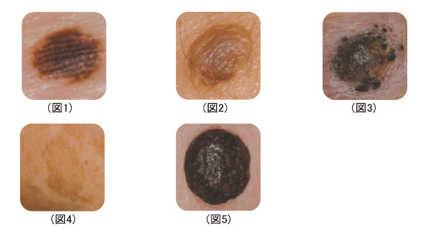 方 見分け が 皮膚 ん