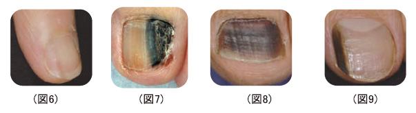 病気のはなし 皮膚科医が皮膚がんを疑うとき 公立学校共済組合 関東中央病院