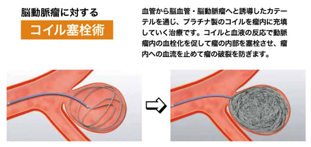 病気のはなし 脳血管内治療 切らない治療 公立学校共済組合 関東中央病院