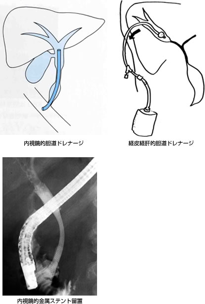 総 胆管 結石