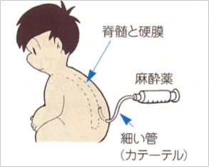 他の手順の代替手段