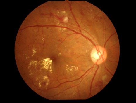 糖尿病網膜症の眼底写真。出血や白斑が散在している