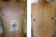 図：単孔式縦隔腫瘍手術（左）と胸骨正中切開（右）