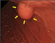 胃粘膜下腫瘍