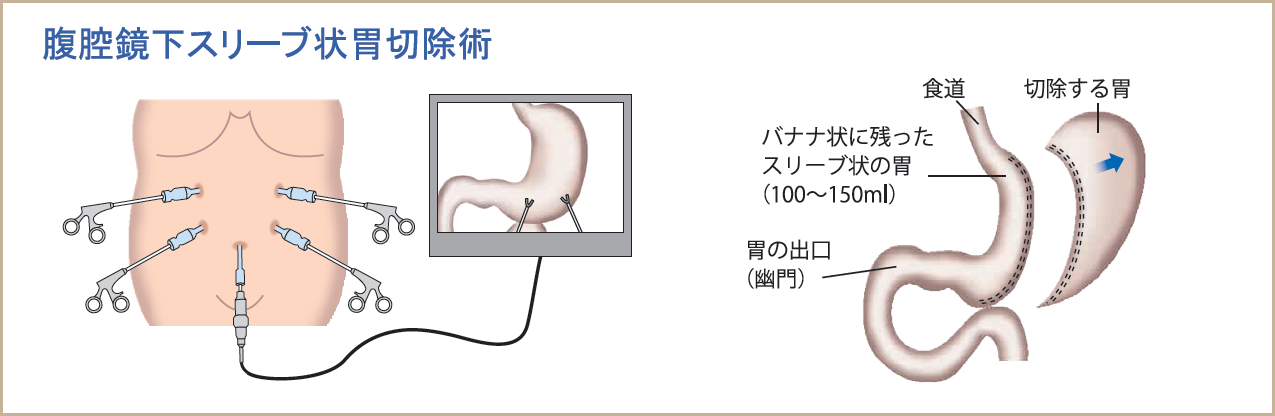 腹腔鏡下スリーブ状胃切除術