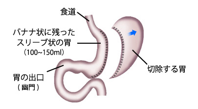 スリーブ状胃切除術