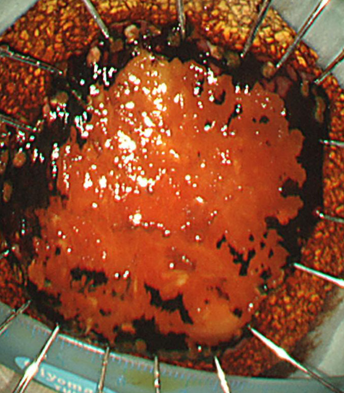 1-3 食道腫瘍50mm検体