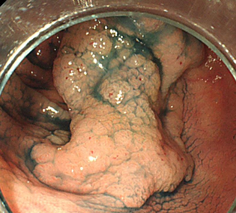 3-1 大腸腫瘍(盲腸部)