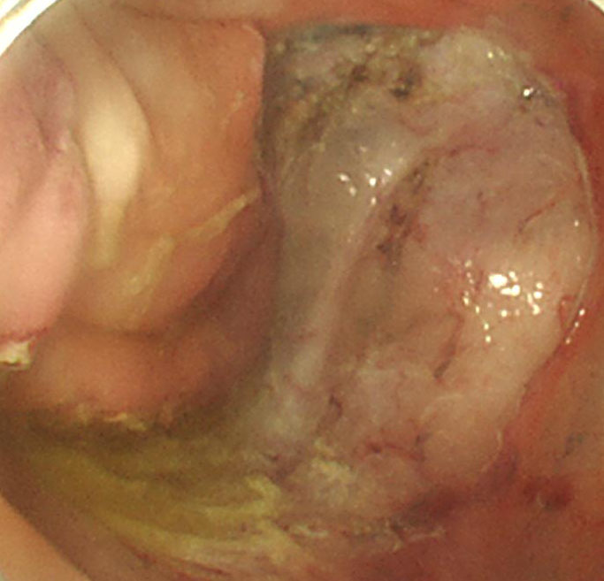 3-2 大腸腫瘍の剝離後