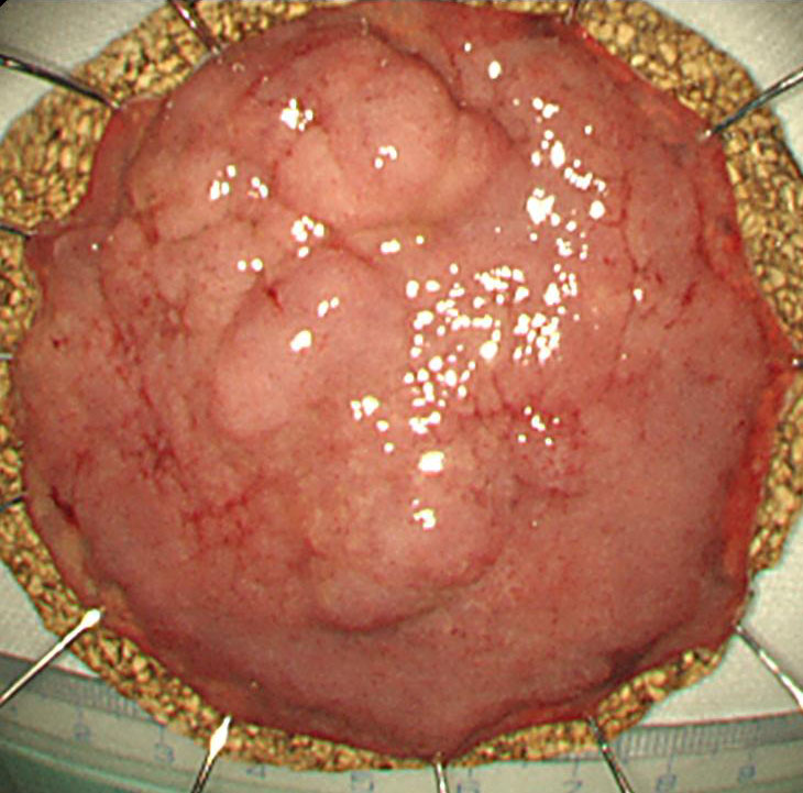 3-3 大腸腫瘍60mm検体
