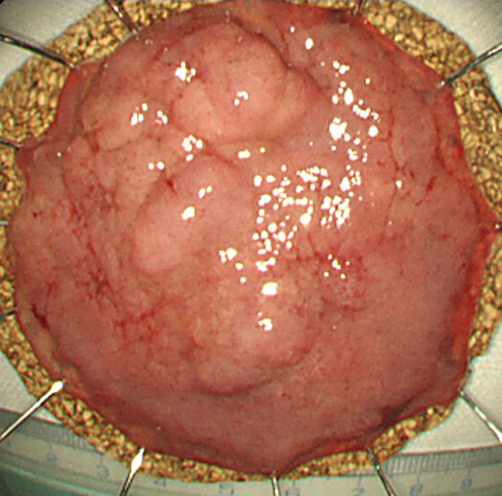 3-3 大腸腫瘍60mm検体