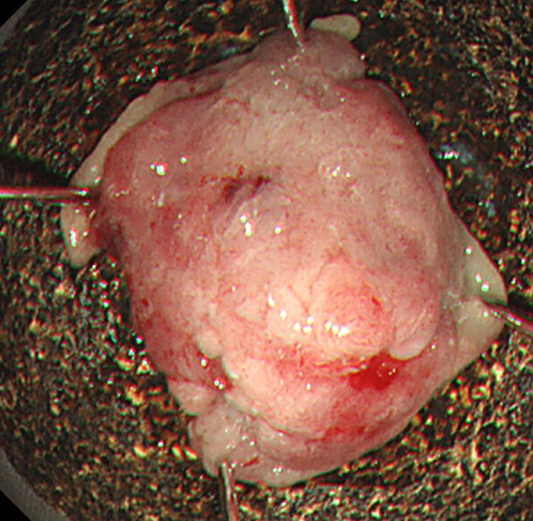 4-4 十二指腸腫瘍30mm検体