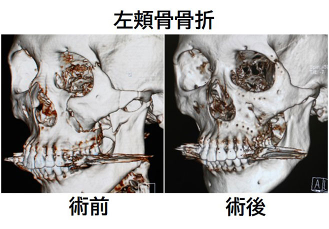 左頬骨骨折