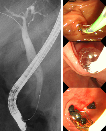 総胆管結石の治療