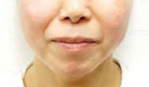 症例:スレッドリフト 施術4週間後