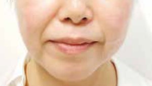症例:スレッドリフト 施術前