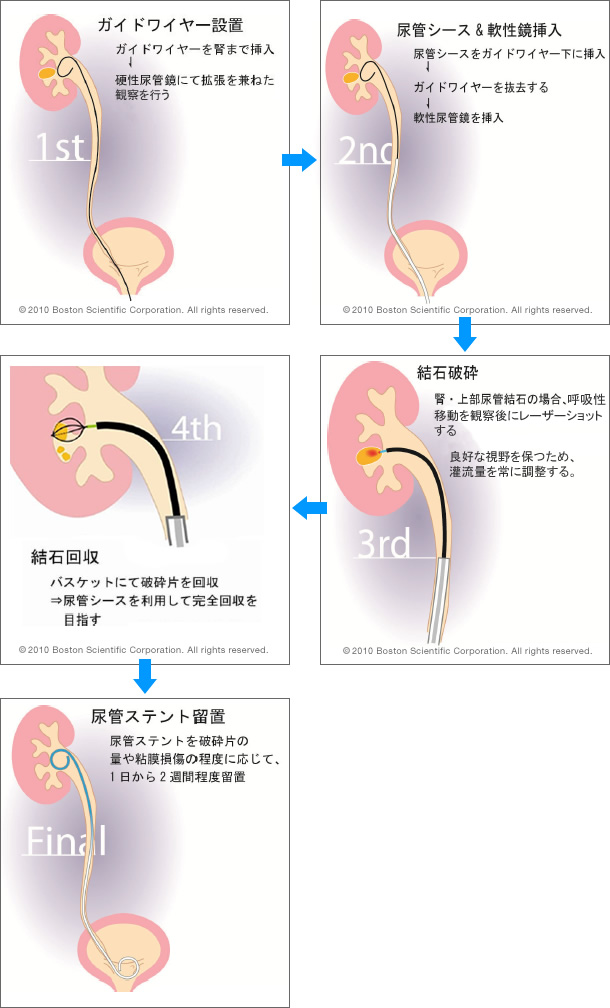 結石 入院 管 尿