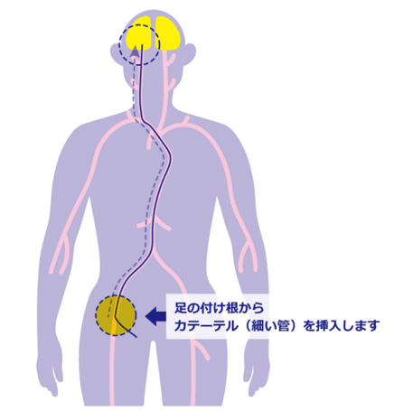 脳血管内治療～切らない治療～