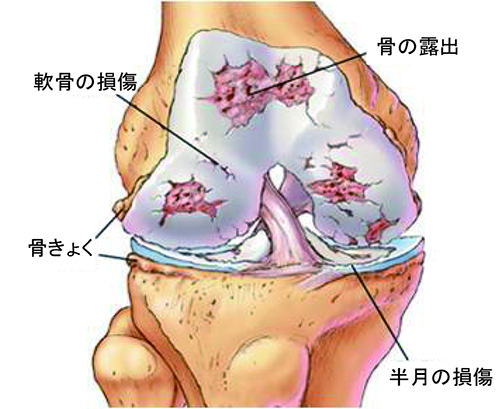 変形性関節症と人工関節置換術