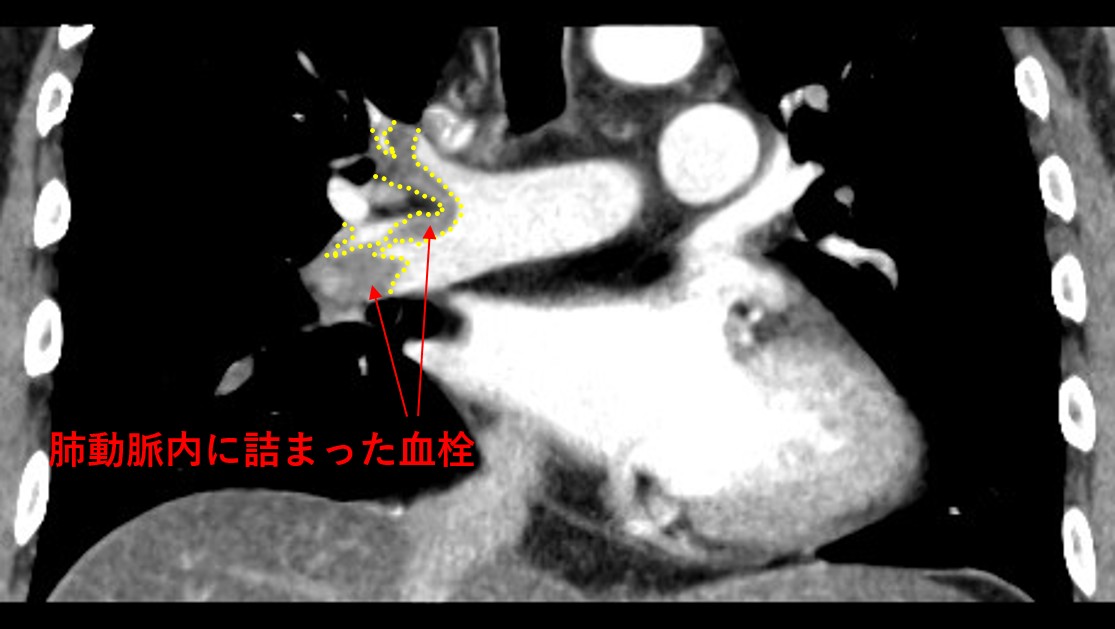 静脈血栓塞栓症（深部静脈血栓症、肺血栓塞栓症）