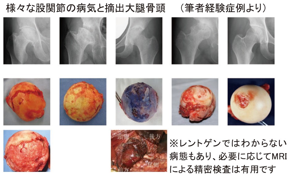 突然の股関節　大腿骨近位部骨折治療と2次骨折予防