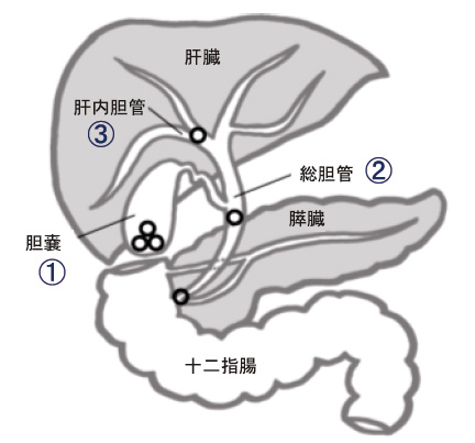 胆石について