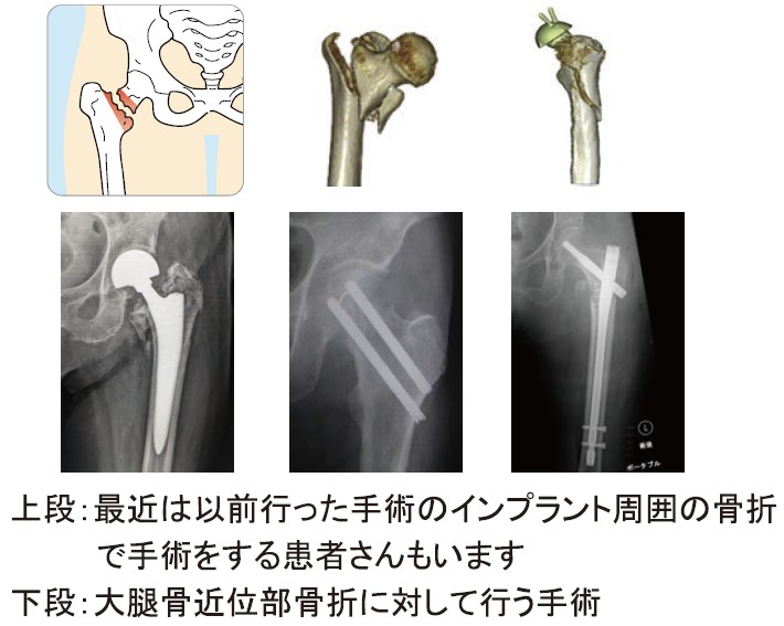 突然の股関節　大腿骨近位部骨折治療と2次骨折予防