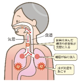 高齢者の誤嚥性肺炎