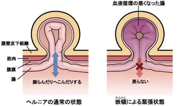 その症状、「鼠径（そけい）ヘルニア」かもしれません