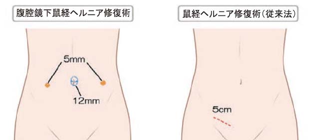 その症状、「鼠径（そけい）ヘルニア」かもしれません