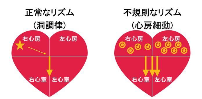心房細動の治療についてお話しします
