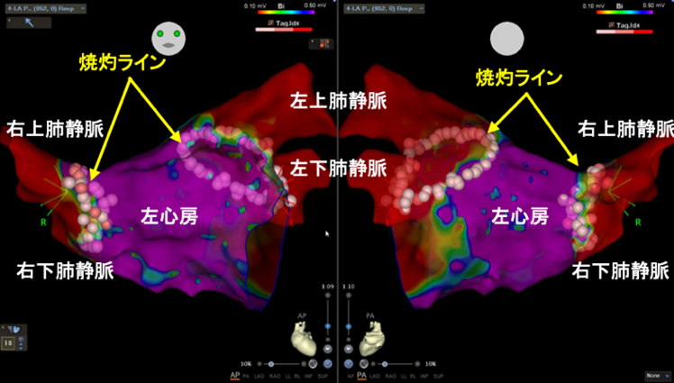 心房細動の治療についてお話しします
